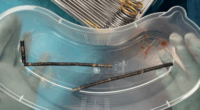 New Zealand teen undergoes surgery after swallowing up to 100 strong magnets ordered on Temu