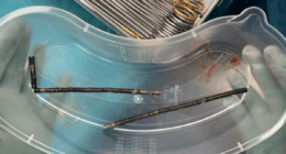 New Zealand teen undergoes surgery after swallowing up to 100 strong magnets ordered on Temu