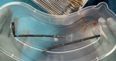 New Zealand teen undergoes surgery after swallowing up to 100 strong magnets ordered on Temu