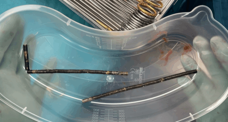 New Zealand teen undergoes surgery after swallowing up to 100 strong magnets ordered on Temu