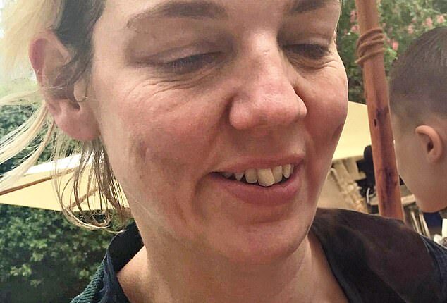Dr Justine Hextall pictured before she made 11 lifestyle changes that had a dramatic impact on her skin