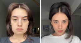 Woman’s ‘Kybella’ Face Transformation Stuns People After Her Extreme Recovery Phase Goes Viral
