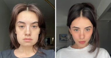 Woman’s ‘Kybella’ Face Transformation Stuns People After Her Extreme Recovery Phase Goes Viral