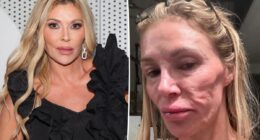 Brandi Glanville shares new health update after grueling battle with her facial disfigurement