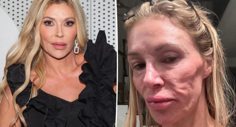 Brandi Glanville shares new health update after grueling battle with her facial disfigurement