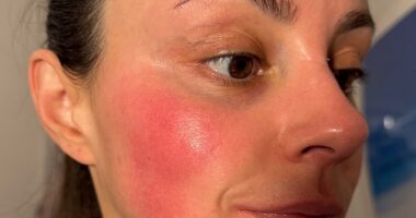 Emma shows off a patch of rosacea on her cheek before the treatment