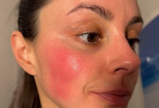 Emma shows off a patch of rosacea on her cheek before the treatment