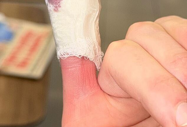 Cruz Beckham showed off a gruesome injury on Saturday as he continues to launch his music career