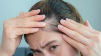 Traction alopecia usually affects the hairline and crown