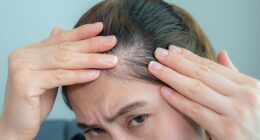 Traction alopecia usually affects the hairline and crown