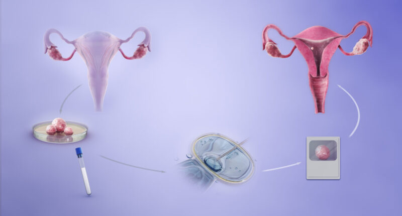 IVF