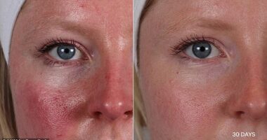 The LYMA Laser Pro retails for $6,000