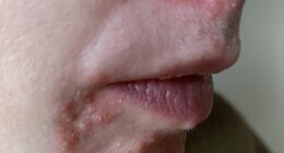 My skin two weeks on from when the condition started... I'd seen no progress