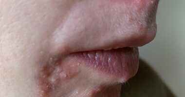 My skin two weeks on from when the condition started... I'd seen no progress