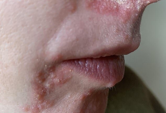 My skin two weeks on from when the condition started... I'd seen no progress