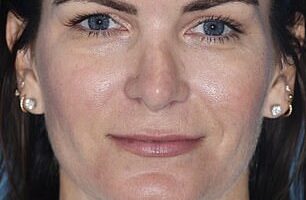 Realtor Erica Wolfe, from Florida, went under the knife on September 24, 2025, forking over $78,000 on multiple procedures including a facelift. She's seen before the surgery