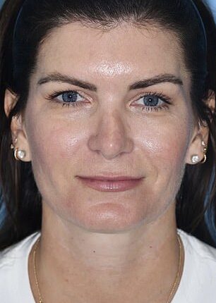 Realtor Erica Wolfe, from Florida, went under the knife on September 24, 2025, forking over $78,000 on multiple procedures including a facelift. She's seen before the surgery