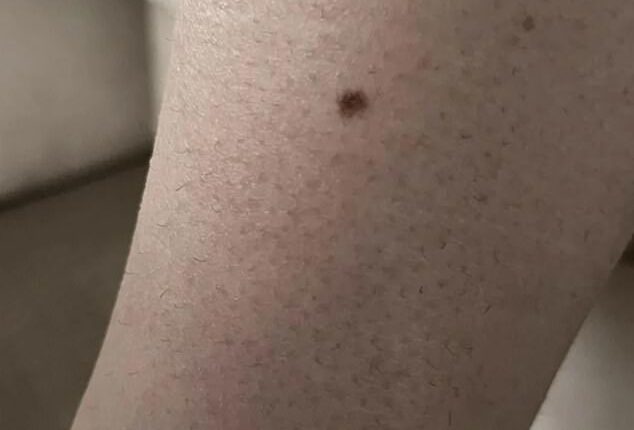 A 30-year-old Aussie woman has made it her mission to share an online annual reminder encouraging people to book a skin check and shared this image of her melanoma in situ, which was diagnosed three years ago following a skin check