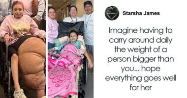 14YO Girl With Rare Condition Undergoes 17 Hours Of Grueling Surgery To Remove 174lb Leg
