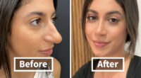67 People Who Became Completely Unrecognizable After Getting Cosmetic Surgery In Turkey