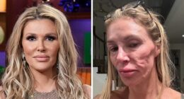 Brandi Glanville Finally Receives Diagnosis For Facial Disfigurement After Blaming A Parasite