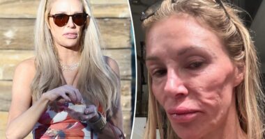 Brandi Glanville says she finally received diagnosis for face disfigurement