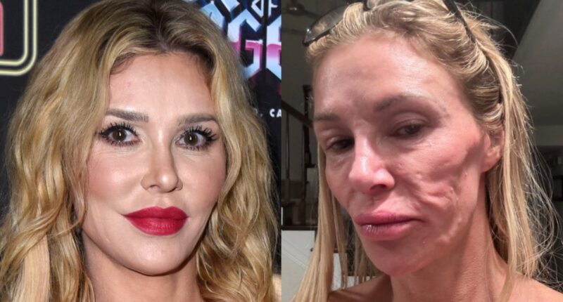 Brandi Glanville says she’s finally received diagnosis for facial disfigurement