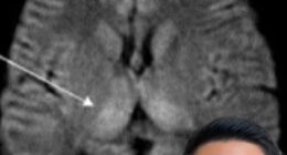 US-based neurologist Dr Baibing Chen (pictured) shared medical scans from a young patient rushed to hospital after eating improperly stored rice, showing damage to deep structures of the brain linked to a rare form of food poisoning known as fried rice syndrome