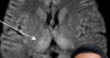 US-based neurologist Dr Baibing Chen (pictured) shared medical scans from a young patient rushed to hospital after eating improperly stored rice, showing damage to deep structures of the brain linked to a rare form of food poisoning known as fried rice syndrome