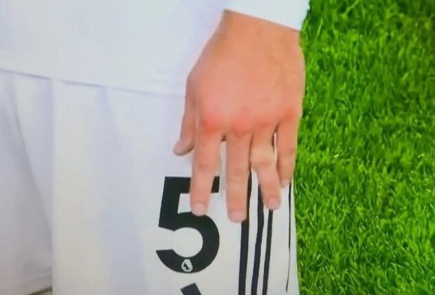 Joachim Andersen appeared to dislocate a finger during Fulham's tie with Nottingham Forest