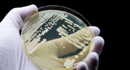 Fungus that causes deadly infections found in over 60 countries globally