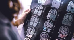 British researchers say a cure for Alzheimer'sdisease could one day be possible, with experts suggesting truly life-changing treatments may emerge within the next five to ten years