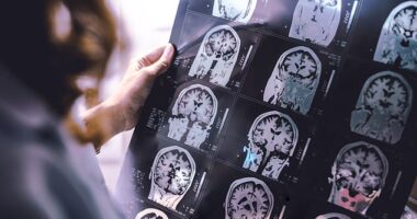 British researchers say a cure for Alzheimer'sdisease could one day be possible, with experts suggesting truly life-changing treatments may emerge within the next five to ten years