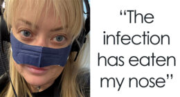 “My Face Is Changing Every Day!”: Woman’s $4k ‘Turkey Teeth’ Procedure Goes Horribly Wrong