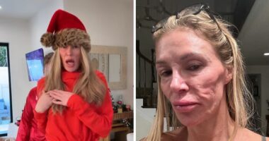 “Psychosis On Display”: Brandi Glanville Goes Bold In Red Bikini After Face Disfigurement Diagnosis