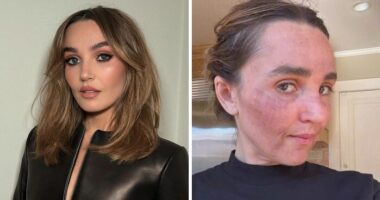 “Really Disturbing”: SNL Star Reveals “Botched” Cosmetic Procedures In Concerning Photos
