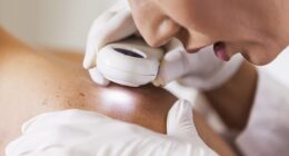 Experts warn melanoma, a type of skin cancer, is not always just on the skin (stock image)