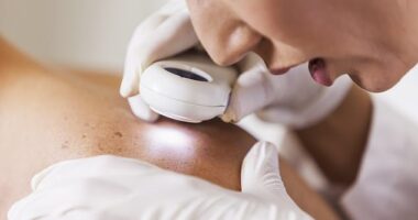Experts warn melanoma, a type of skin cancer, is not always just on the skin (stock image)