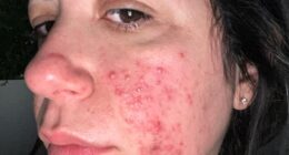 Nadine Arbiter developed a full face of bright red acne that was 'incredibly sore'