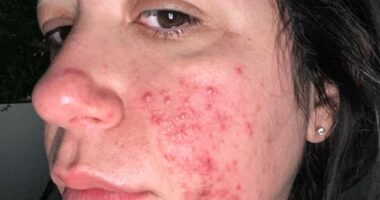 Nadine Arbiter developed a full face of bright red acne that was 'incredibly sore'