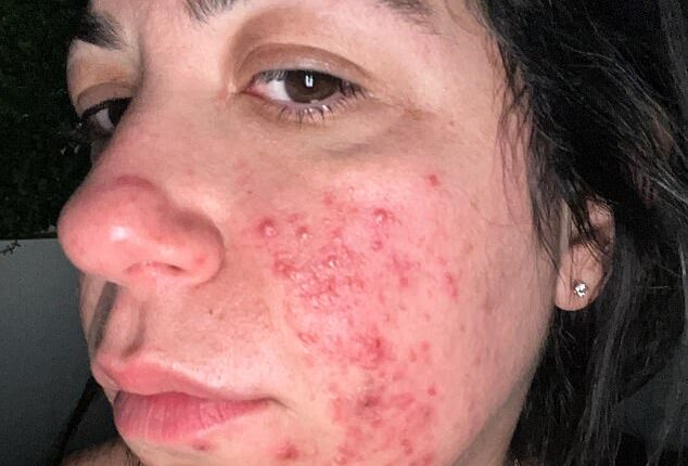 Nadine Arbiter developed a full face of bright red acne that was 'incredibly sore'