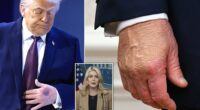 The White House has a new reason for why Donald Trump's hands are consistently bruised. The President's Press Secretary, Karoline Leavitt, told CBS News that Trump 'hit his hand' on the corner of the signing table at the Board of Peace event on Thursday in Davos, Switzerland, 'causing it to bruise.' The noticeable contusion was seen on Trump's left hand, which is not the one normally covered with makeup to conceal the discoloration of a bruise. Previously, Leavitt has said that Trump's right hand is chronically bruised because of the frequency in which he shakes people's hands.