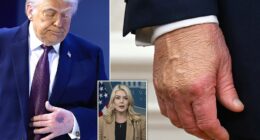 The White House has a new reason for why Donald Trump's hands are consistently bruised. The President's Press Secretary, Karoline Leavitt, told CBS News that Trump 'hit his hand' on the corner of the signing table at the Board of Peace event on Thursday in Davos, Switzerland, 'causing it to bruise.' The noticeable contusion was seen on Trump's left hand, which is not the one normally covered with makeup to conceal the discoloration of a bruise. Previously, Leavitt has said that Trump's right hand is chronically bruised because of the frequency in which he shakes people's hands.