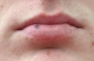 Harry's lip mole before treatment