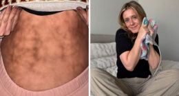 Woman’s Video Goes Viral After She Shows How Her Body Looks After Using A Heating Pad: “Toasted Skin Syndrome”