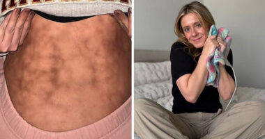 Woman’s Video Goes Viral After She Shows How Her Body Looks After Using A Heating Pad: “Toasted Skin Syndrome”