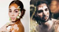 35 Stunning Portraits That Celebrate The Unique Beauty Of People With Vitiligo