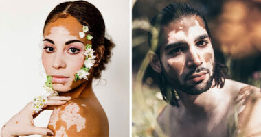 35 Stunning Portraits That Celebrate The Unique Beauty Of People With Vitiligo
