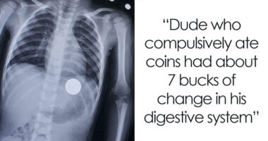 44 Autopsy Findings That Were So Strange, Even Doctors Were Speechless
