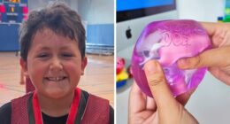 9-Year-Old Suffers Severe Facial Burns After Dangerous TikTok Trend Goes Horribly Wrong